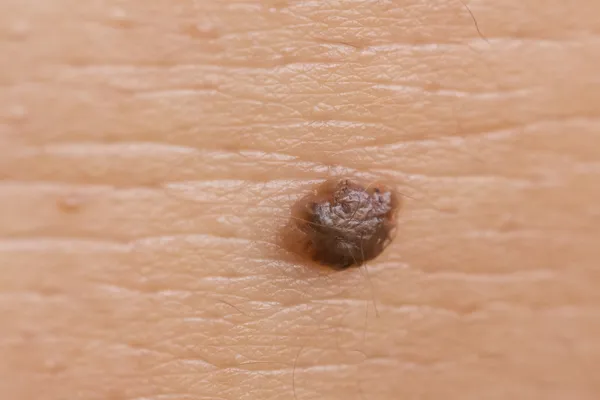 MedAL - Skin Cancer Detection System