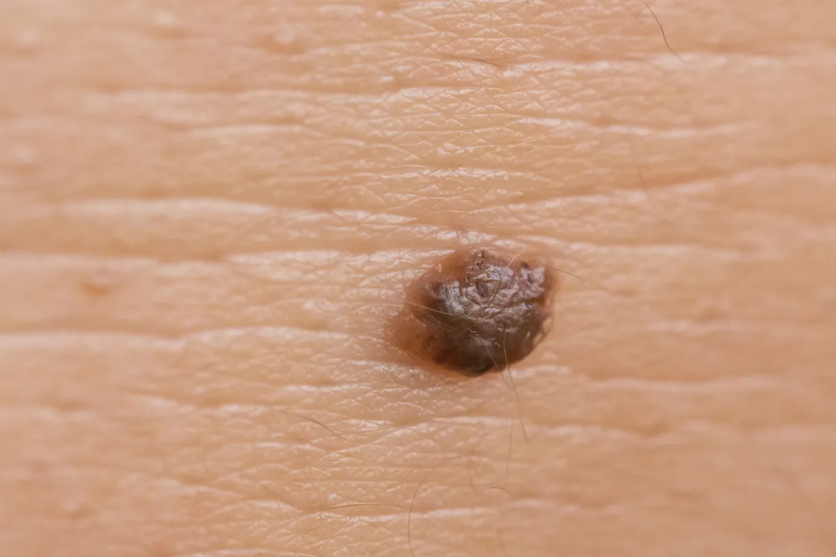MedAL - Skin Cancer Detection System